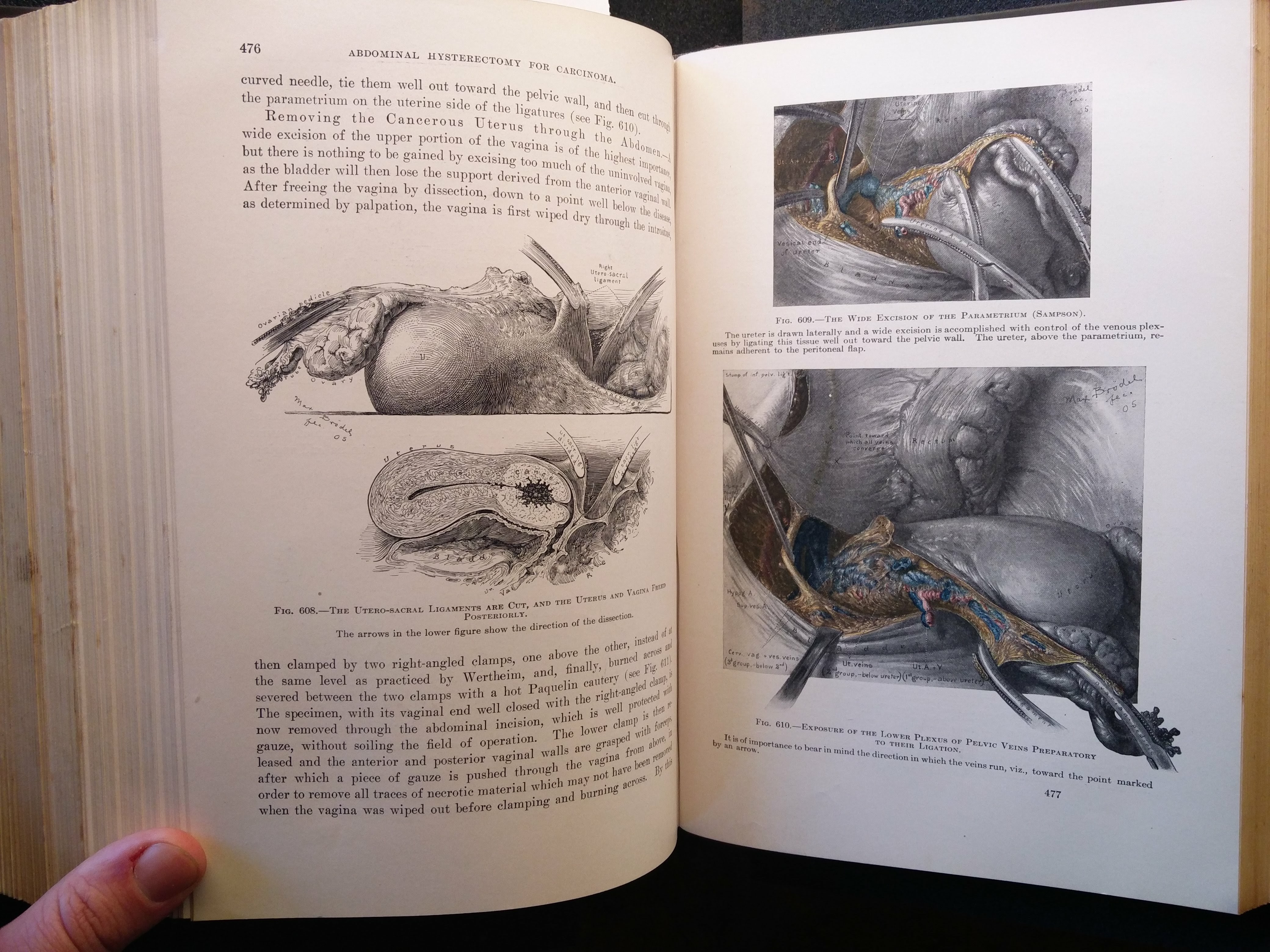 "Max Brödel’s hauntingly fantastic anatomical illustrations for Kelley’s Operative Gynecology (London, 1906 – Bodleian RSL 1619 d.49)"